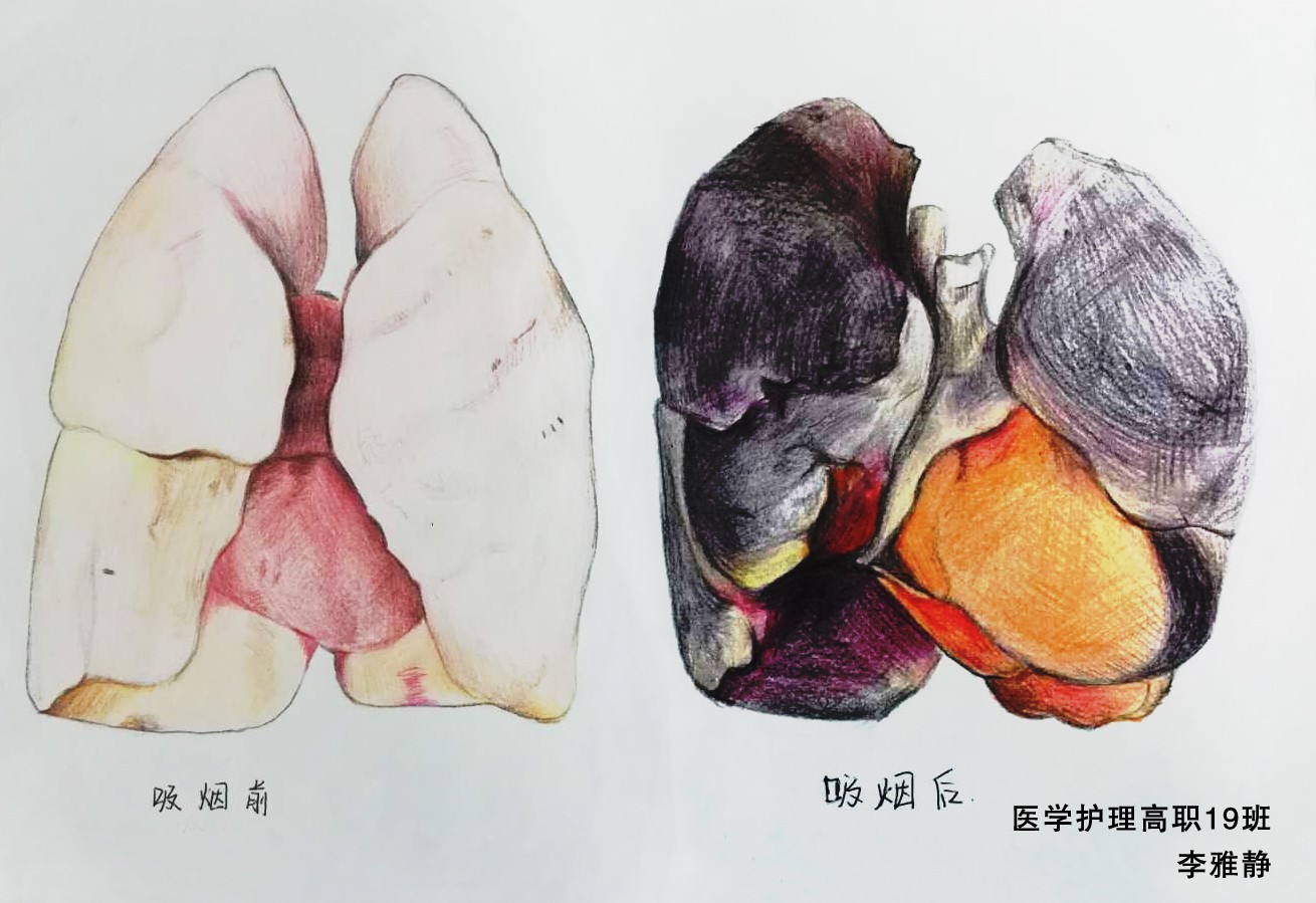 卫生健康学院举办世界无烟日吸烟前后肺部解剖对比图绘画比赛